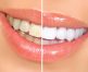 Teeth whitening Grand Rapids MI cosmetic dentists