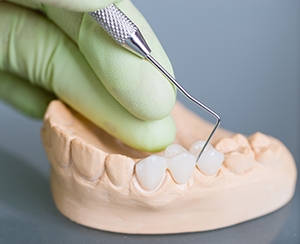 Dental bridge Grand Rapids MI dentists